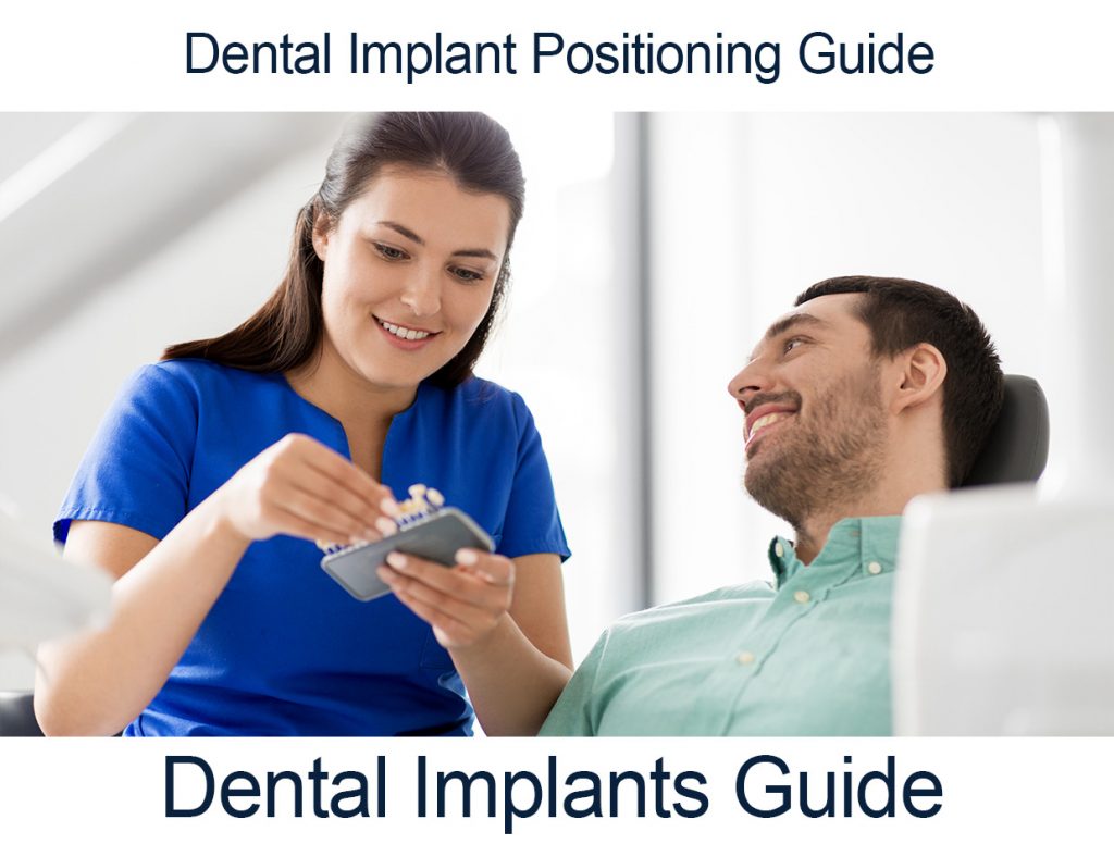 Dental implants guide