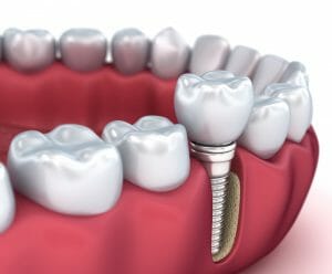 Affordable dental implants cost