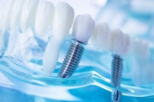 The Average Cost Of Dental Implants
