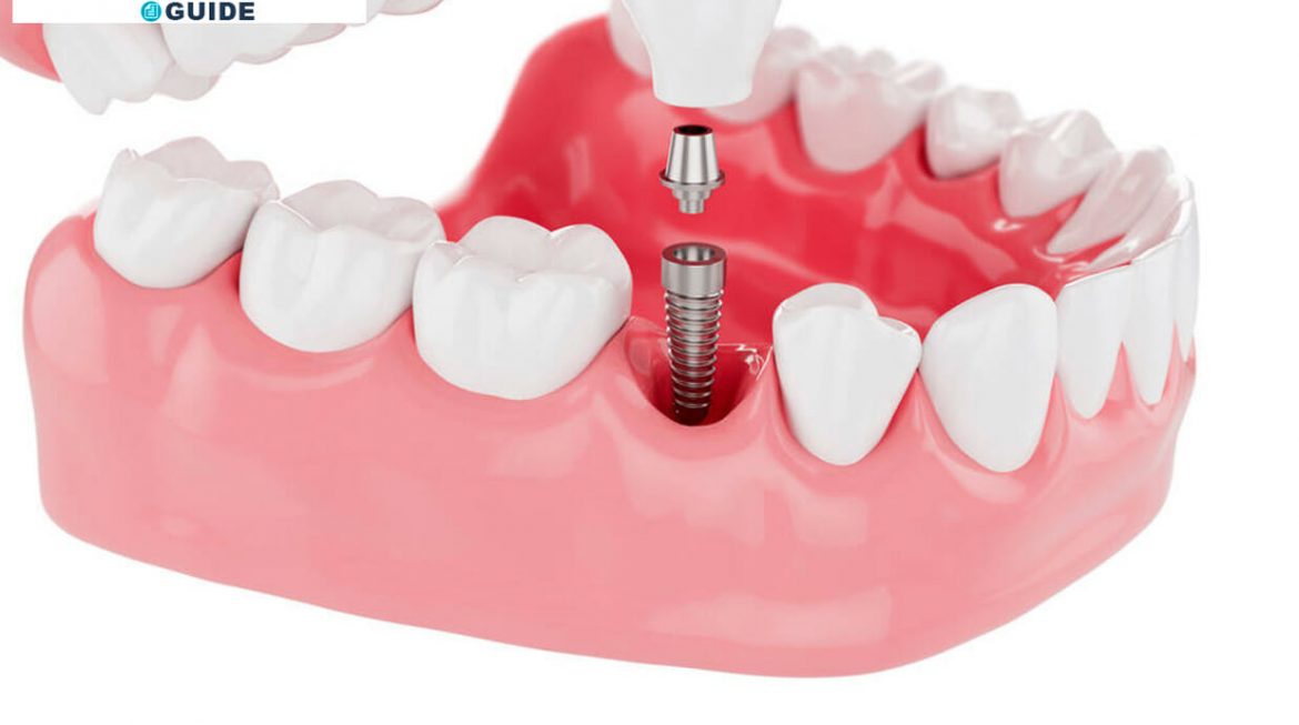 Dental Implants:  How They Can Change Your Life For The Better