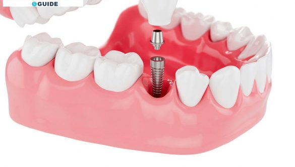 Dental Implants:  How They Can Change Your Life For The Better