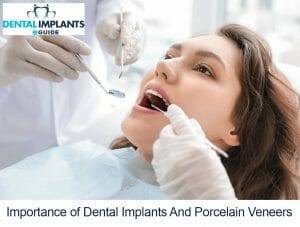 Importance of Dental Implants And Porcelain Veneers