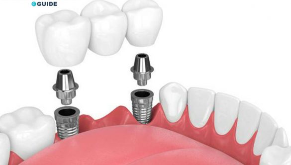 What Do Dental Implants Look Like?