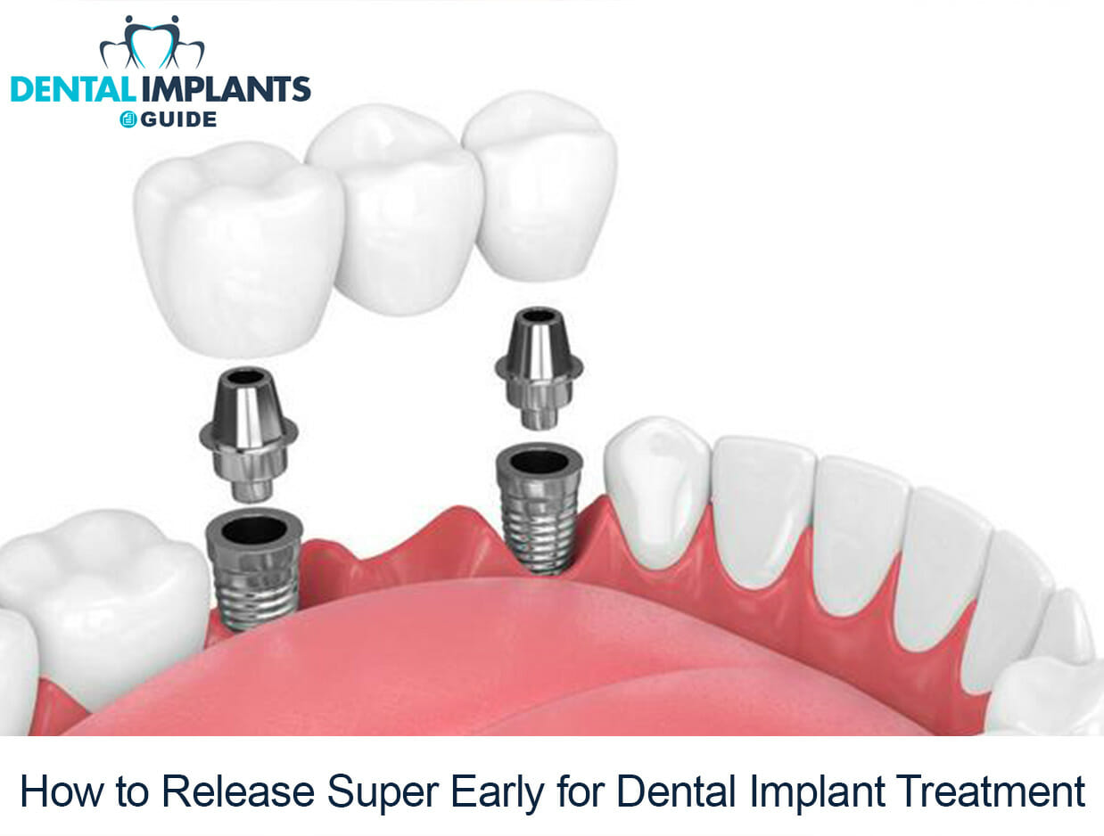 How to Release Super Early for Dental Implant Treatment